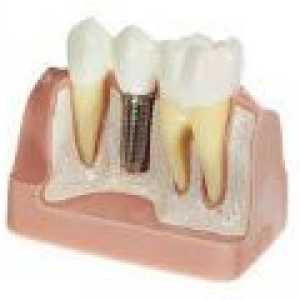 Implanturi dentare Metode