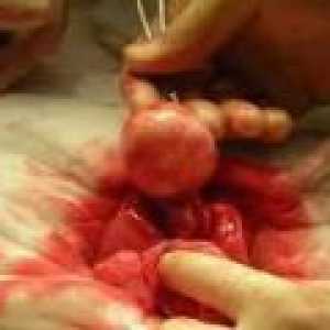 Fibromul uterin dimensiuni mici - cauze, tratament