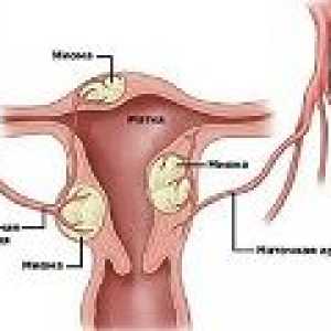 Fibrom uterin in timpul sarcinii, cauze, tratament