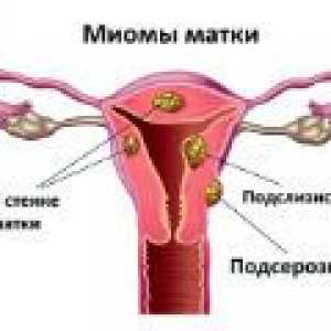 Fibrom uterin multiple - cauze, simptome, tratament