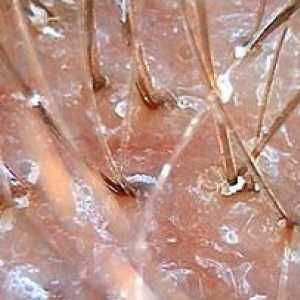 Cele mai eficiente metode de tratament a dermatitei seboreice a scalpului