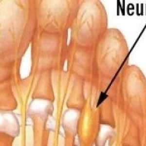 Morton Neuroma (picior in gat) - cauze, simptome și tratament