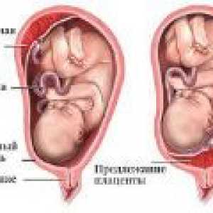 Placentation scăzut în timpul sarcinii, ce este?