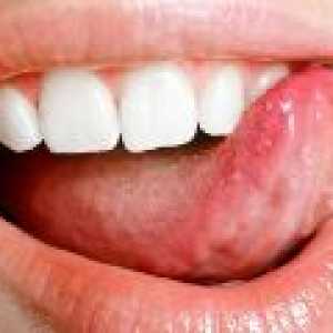 Amorțeală a limbii, cauze, tratament