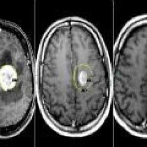 Brain tumorii - cauze, simptome, tratament