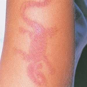 Proprietăți manifestări alergice ale dermatitei