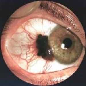 Diagnosticul și tratamentul melanomului ochi