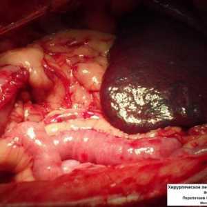 Caracteristici ale perioadei postoperatorie după îndepărtarea colonului și tumori