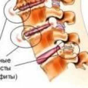 Osteofite a coloanei cervicale: cauze, tratament