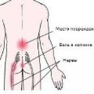 Osteochondrosis sacrală - simptome, tratament