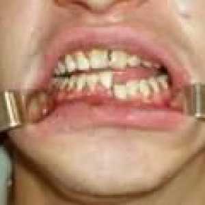 Fractură de maxilar: cauze, simptome, tratament