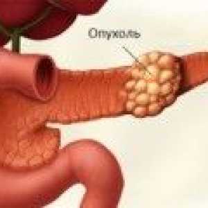 Primele simptome ale cancerului pancreatic