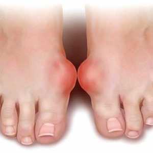 Gout: simptome și tratament