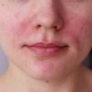 Înroșire și inflamație a pielii, tratamentul