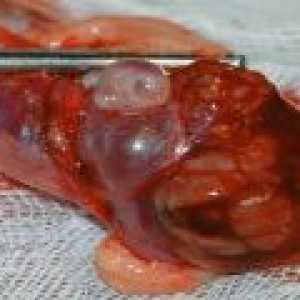 Ovare polichistice: simptome, diagnostic, tratament