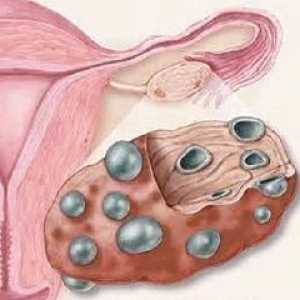 Ovare polichistice