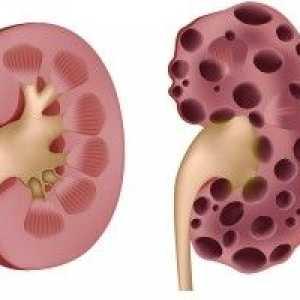 Boli de rinichi polichistic - cauze, simptome și tratament