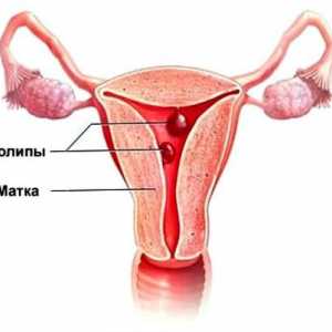Polipii in uter: simptome și tratament