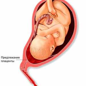 Placenta previa și localizarea placentei, care sunt