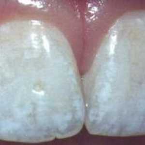 Cauzele pete albe pe dinti