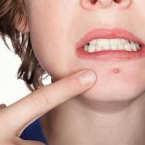 Cauzele acneei asupra organismului uman: o prezentare detaliată
