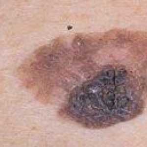Caracteristicile și particularitățile tratamentul fazei melanom 3