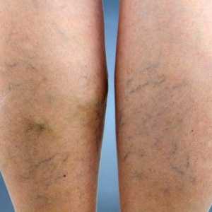 Prevenirea venelor varicoase la nivelul picioarelor