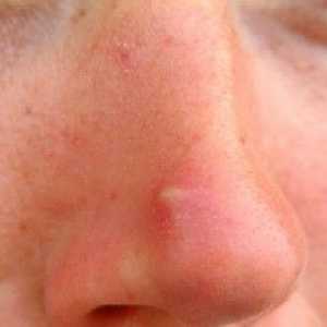 Cosurile de pe nas: a cauzelor, de tratament și de prevenire