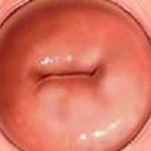 Pseudo col uterin - cauze, simptome, tratament