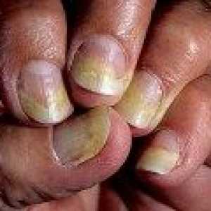 Psoriazis unghii pe mâini și picioare tratament