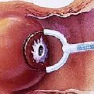 Tratamentul Radiowave de eroziune de col uterin
