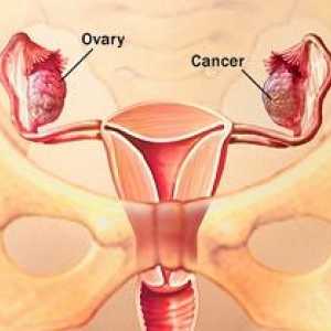 Cancer ovarian