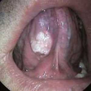 Cancer de limba