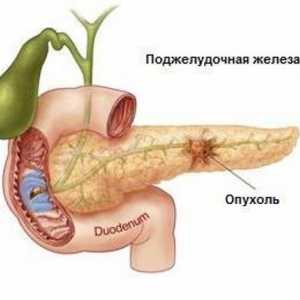Cancer pancreatic: simptome precoce