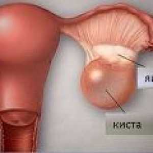 Ruperea unui chist ovarian - cauze, simptome, tratament
