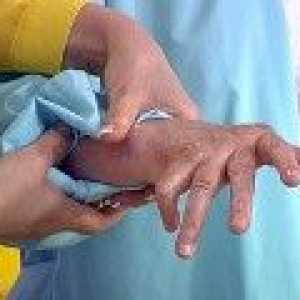 Artrita reumatoidă: tratamentul metodelor contemporane și tradiționale