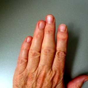 Artrita reumatoida a degetelor, primele simptome