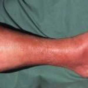 Picioare erizipel, simptome și tratament