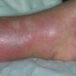 Picioare erizipel - simptome, tratament
