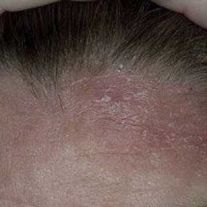 Dermatita seboreica: simptome, cauze, tratament
