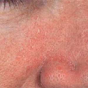 Dermatita seboreica (eczeme gras) facial: cauze, tratamentul si prevenirea