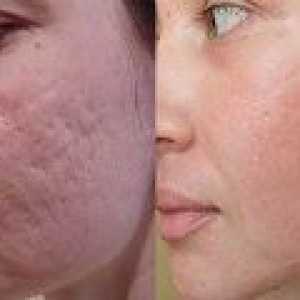 Cicatrici acnee - cum să eliminați?