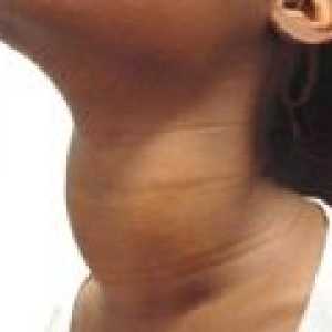 Simptomele de hipotiroidism la femei