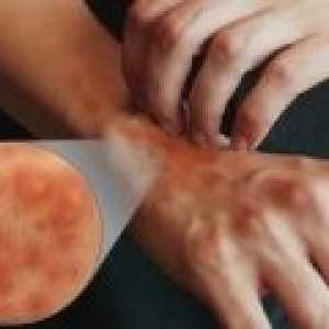 Simptomele și tratamentul dermatitei atopice