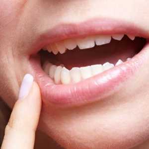 Simptome și metode pentru tratarea candidozei orale