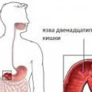 Simptomele de ulcer duodenal acut