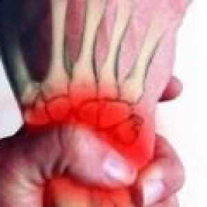 Complex de sindromul de durere regională: cauze, simptome, tratament