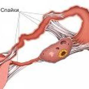 Aderențele în trompele uterine, cauze