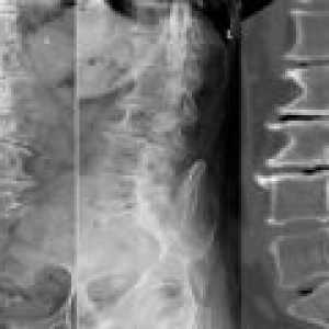 Coloanei vertebrale lombare Spondylarthrosis