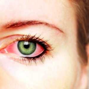 Metode de tratare a ochilor conjunctivitei